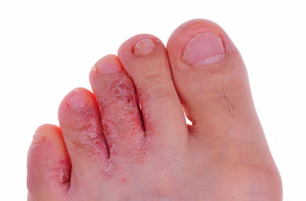 Chapped toes hot sale