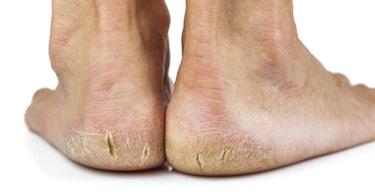 podiatrists can treat cracked feet and cracked heels in many ways