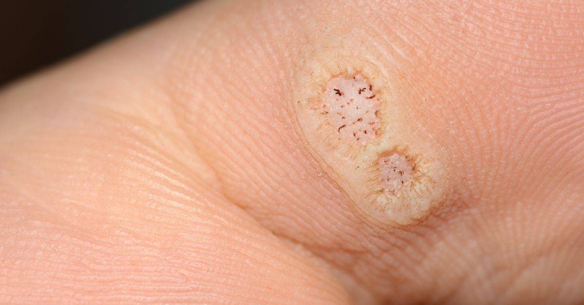 how to get rid of plantar warts using a range of podiatrist treatments