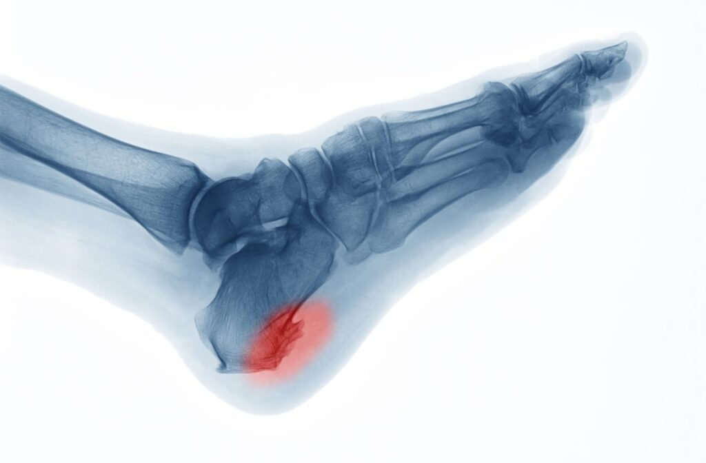heel spurs are a cause for heel pain and mimic the symptoms of plantar fasciitis