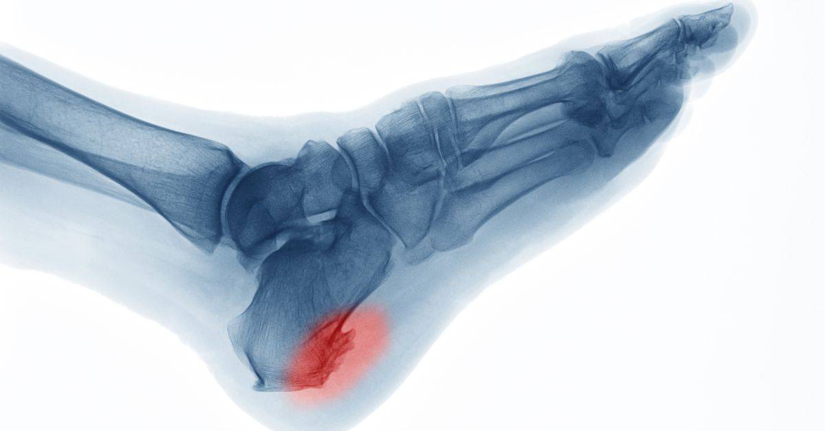 Heel spurs are a cause for heel pain and have symptoms alike to plantar fasciitis