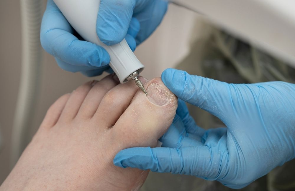 The Ultimate Ingrown Toenail Survival Guide! | Healthy Life Foot Clinic