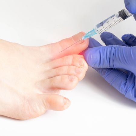 how-do-you-treat-ingrown-toenails