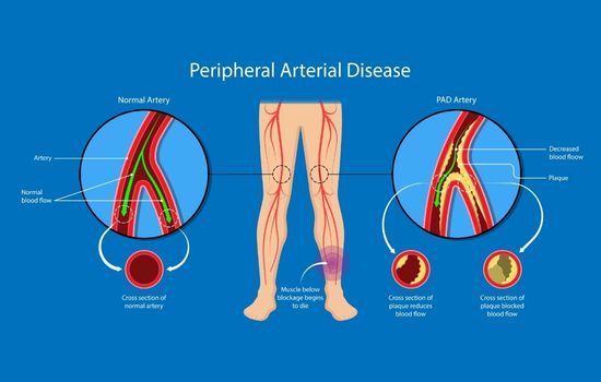 Peripheral Artery Disease