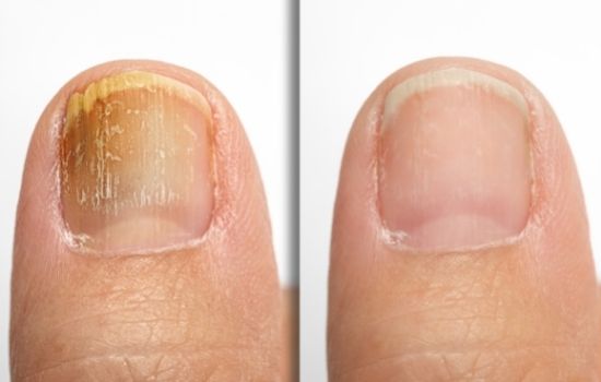 how-does-the-fungal-nail-laser-work-2