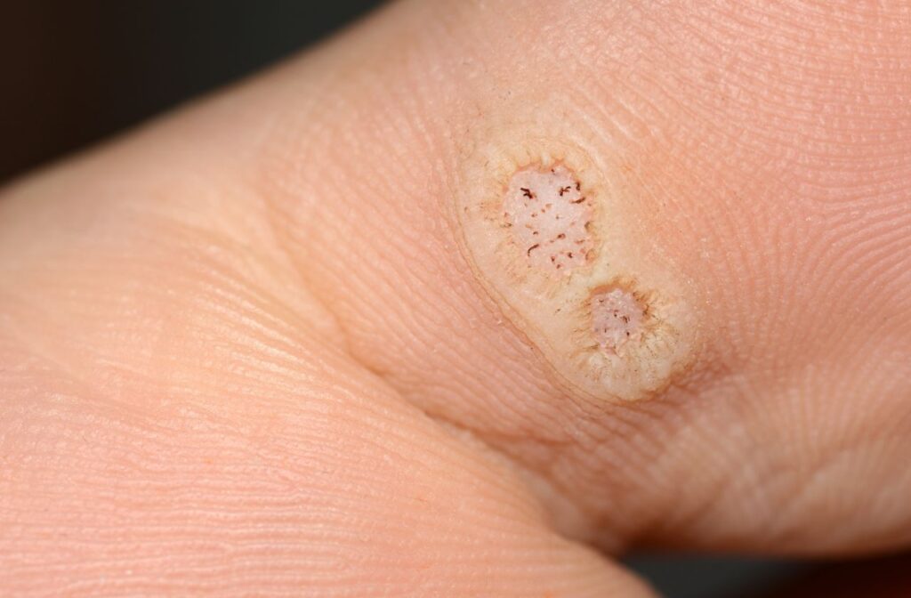 plantar warts need effective treatment to get rid of plantar warts like swift microwave therapy for plantar warts