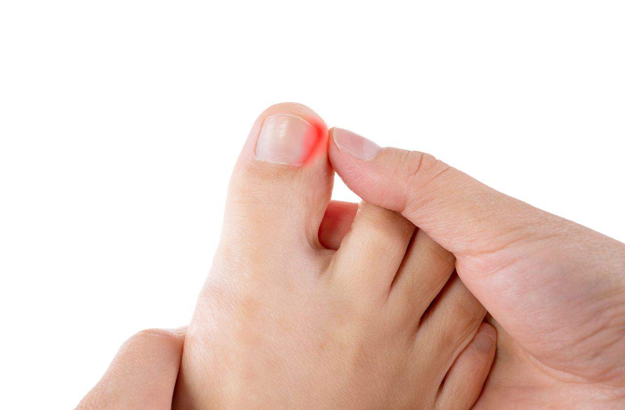 If you wonder how to treat an ingrown toenail wonder no more with our podiatry advice. Picture of a foot with toenail infection highlighted.