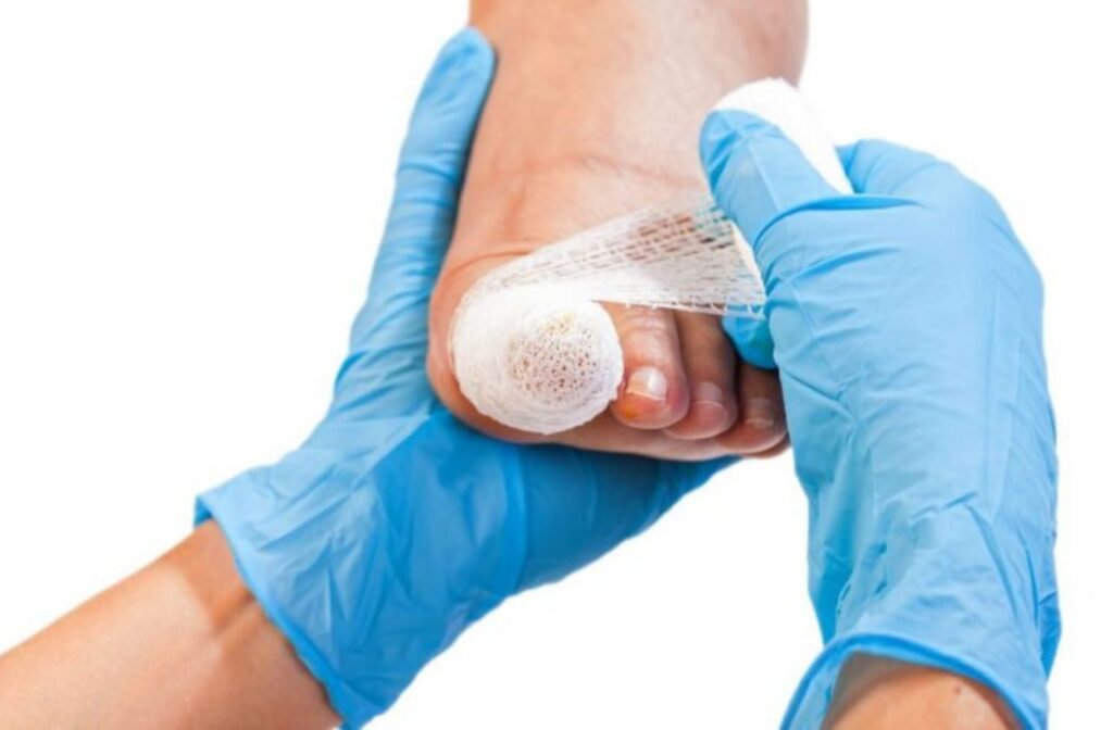 after and ingrown toenail surgery you may need to rest your foot for a day or two