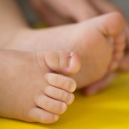 ingrown toenails in infants