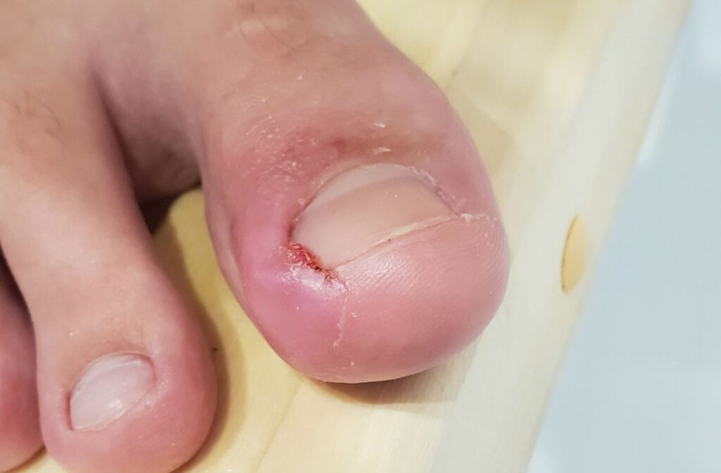 Why You Shouldn't Ignore Ingrown Nails: Vittori Foot & Ankle