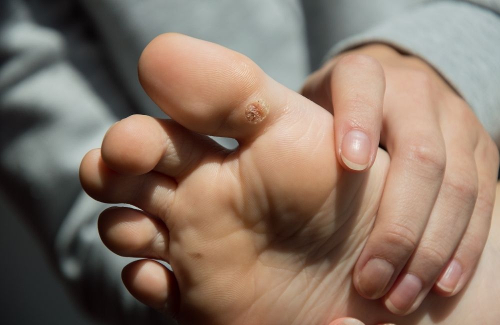what-are-plantar-warts-1