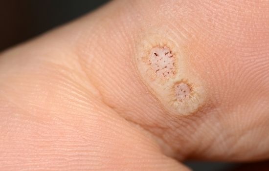 what-are-plantar-warts-3