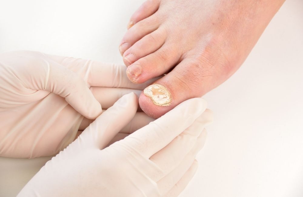 what-can-cause-a-fungal nail-infection-1