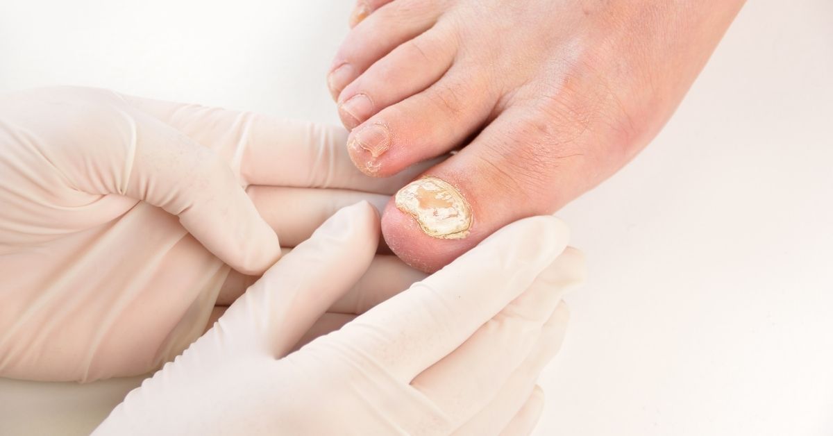 what-can-cause-a-fungal nail-infection