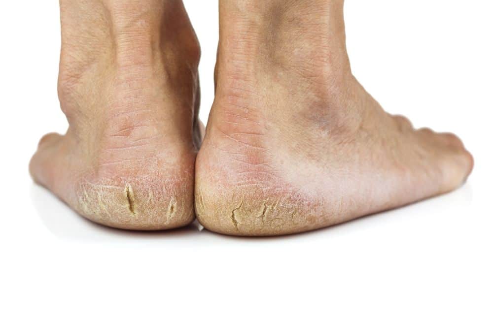 what-causes-dry-feet cracked heels