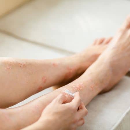 Eczema and Psoriasis