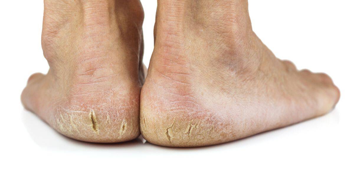 what-causes-dry-feet cracked heels