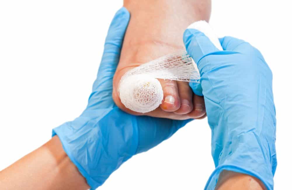 Ingrown Toenail Treatment Melbourne | Foot Clinic