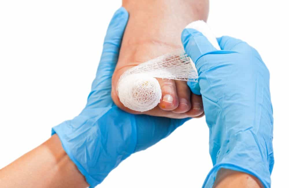 what-is-ingrown-toenail-surgery podiatrist bandages ingrown toenail