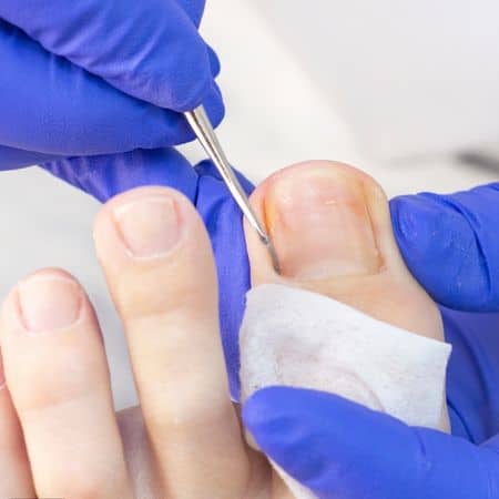 Ingrown Toenail Treatments, Surgical Removal