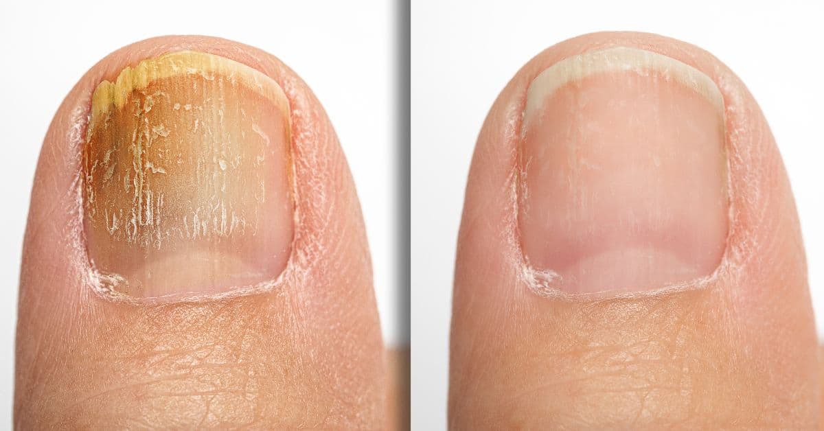 nail fungus is treatable by brisbane podiatrists using laser and other techniques
