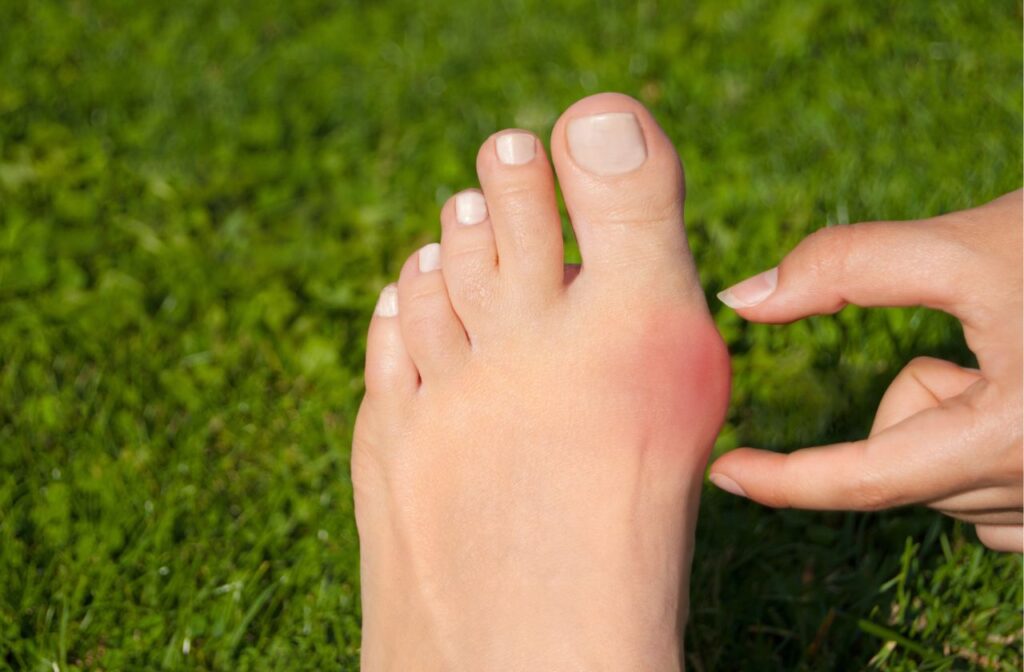 bunions how to shrink naturally