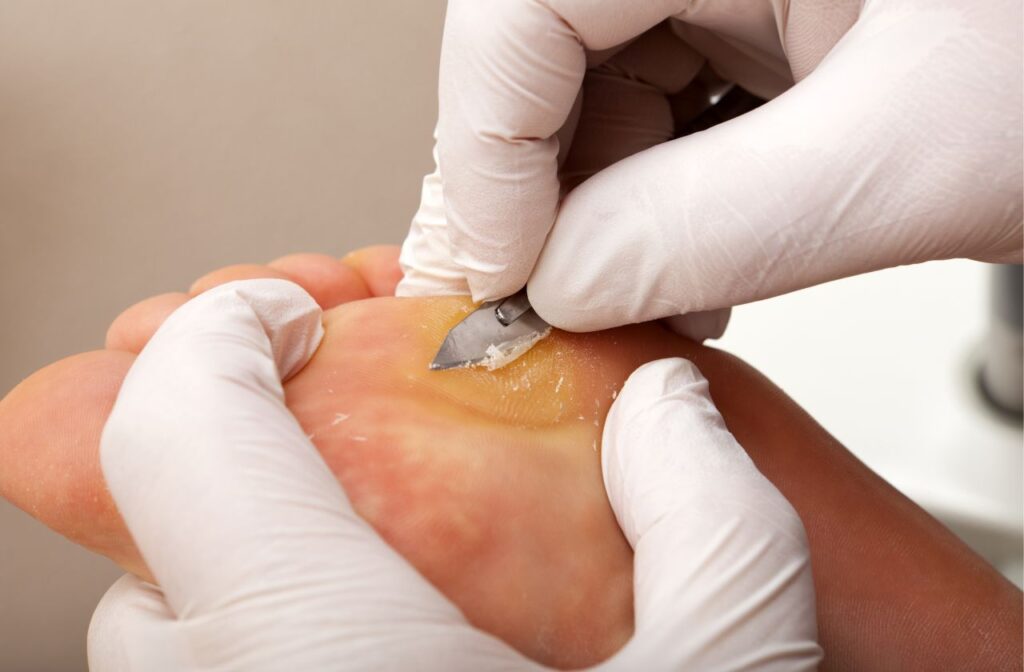 clinical podiatry is a podiatrist led treatment for callus