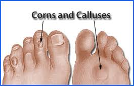 Preventing and Treating Calluses and Corns — Advanced Feet & Ankle