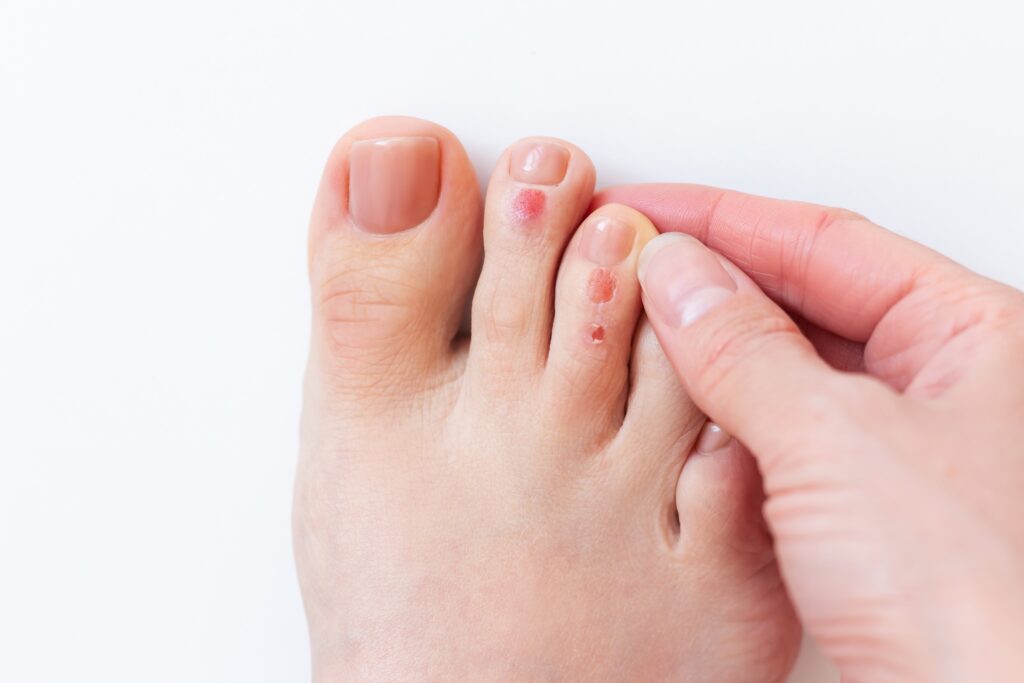 step by step guide to treating and preventing foot blisters