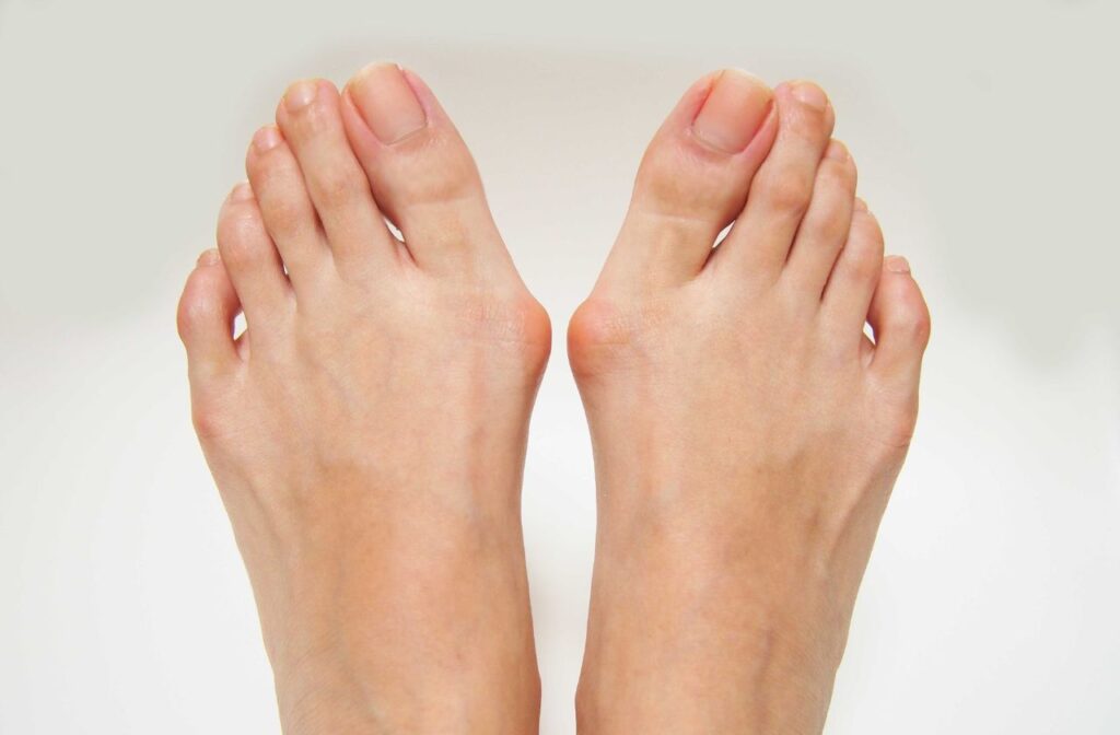 Bunions are a bony growth on the side of your foot caused by the big toe joint becoming misaligned