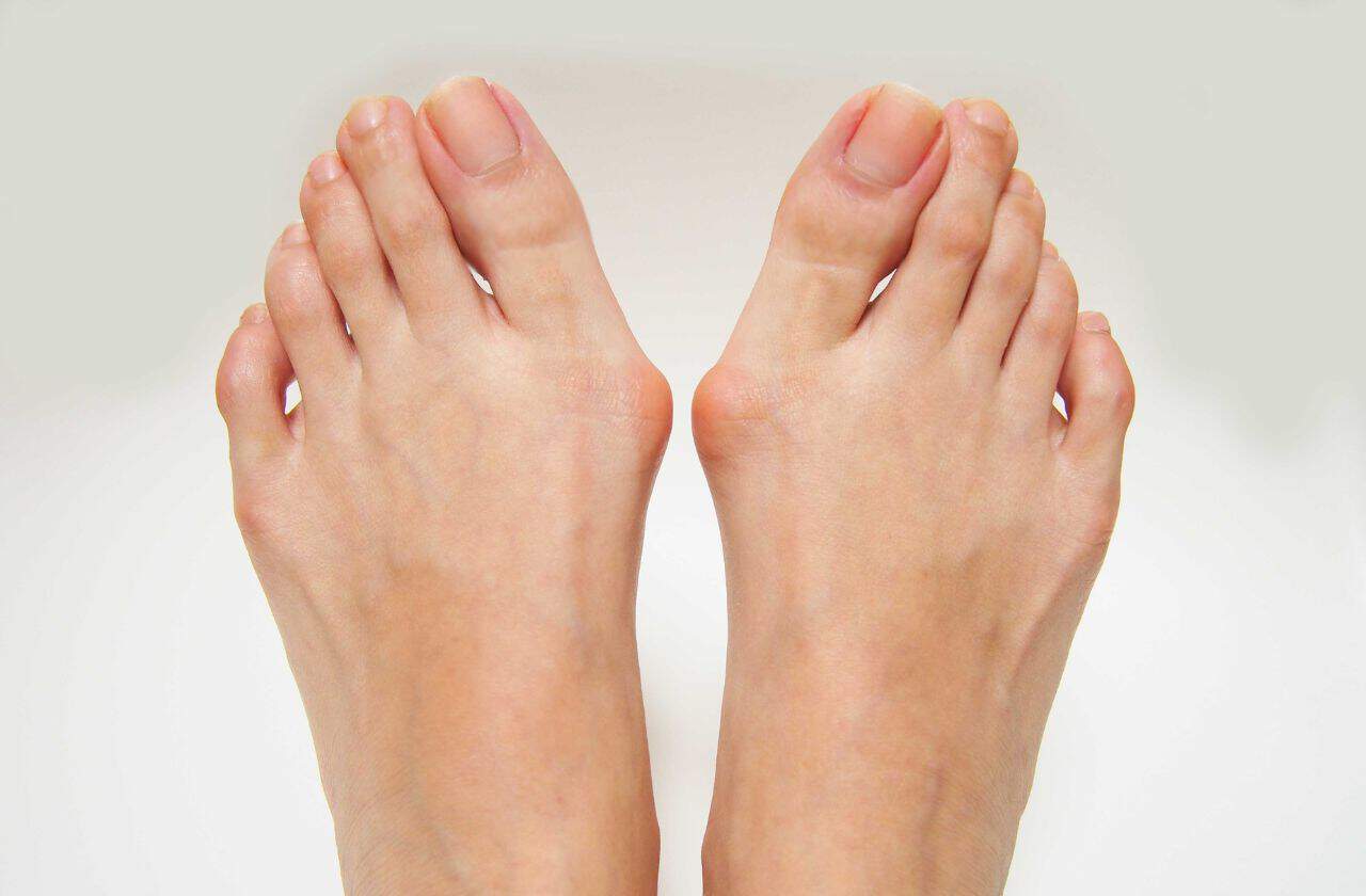 Bunions are a bony growth on the side of your foot caused by the big toe joint becoming misaligned