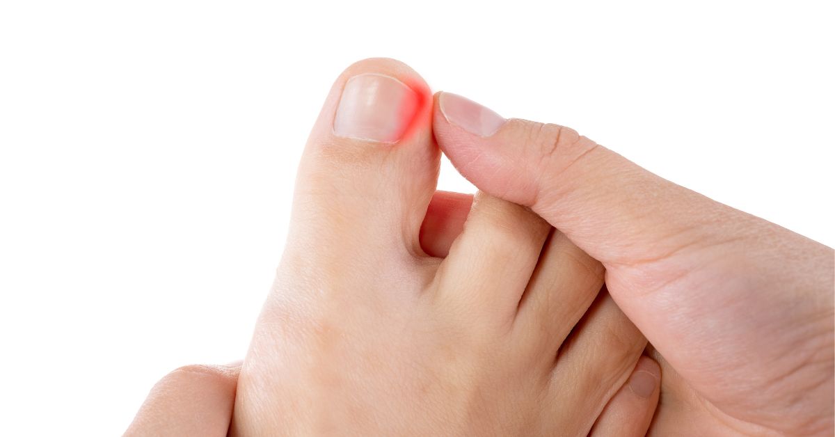 Foot with an ingrown toenail condition on the big toe