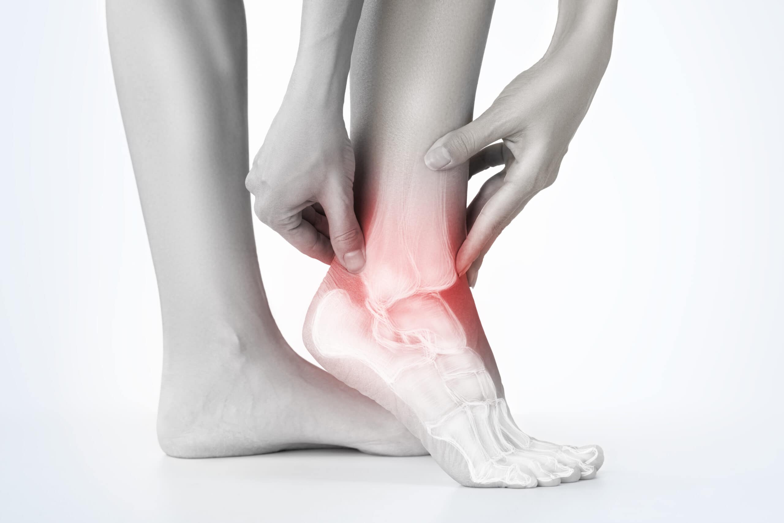 Sinus Tarsi Syndrome affects the small divot on the outside of your ankle causing pain and inflammation to the area