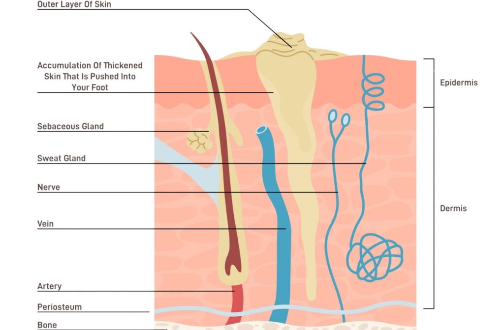 Diagram showing the macroscopic skin changes of a corn and callus