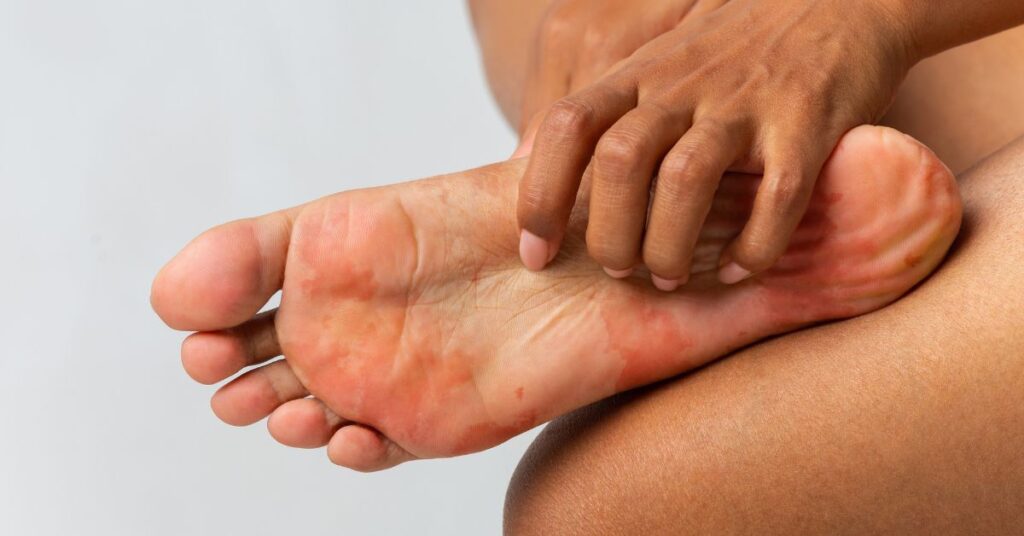 why are my feet itchy dry skin